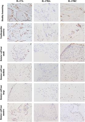 Interleukin-17 Cytokines and Receptors: Potential Amplifiers of Tendon Inflammation